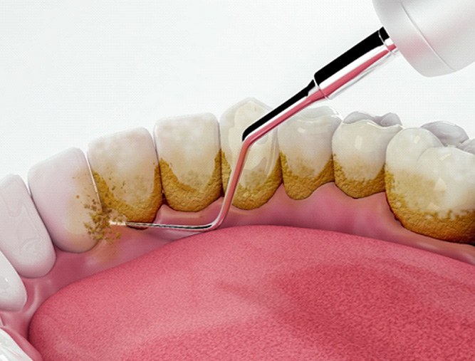 3D render of teeth being cleaned