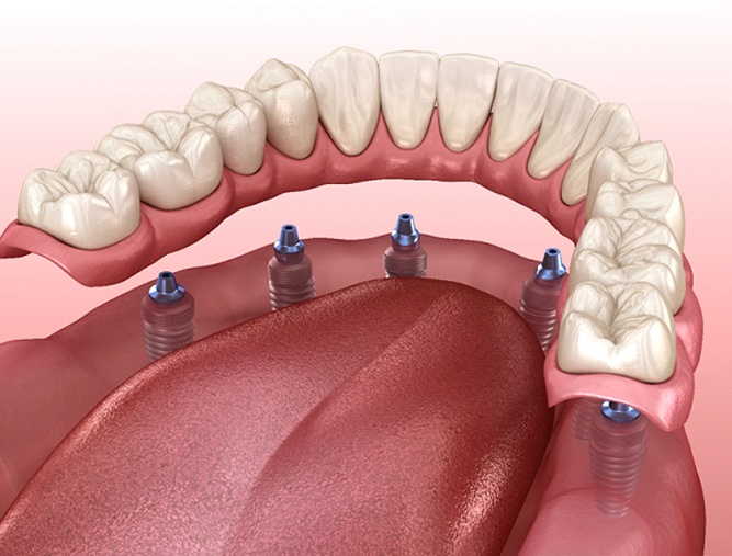 A digital image of an implant denture being placed over six dental implants on the lower arch