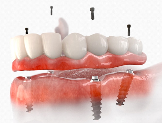 A digital image of an implant denture sitting on top of four dental implants on the lower arch