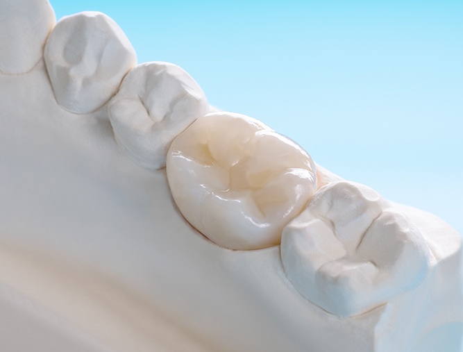 Model smile with a dental crown restoration