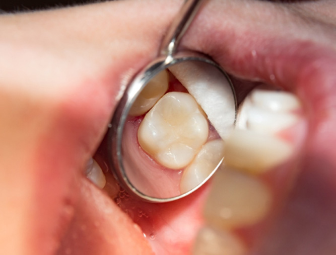 A dental mirror showing a tooth-colored filling