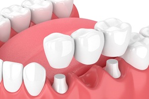 Illustration of traditional dental bridge in Westlake Hills