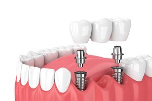 Illustration of implant bridge in Westlake Hills