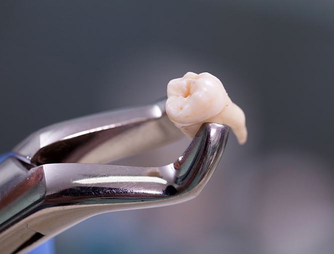 Metal clasp holding an extracted tooth