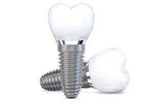 examples of the cost of dental implants in Austin