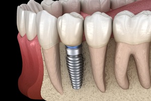 dental implant fusing to the jawbone
