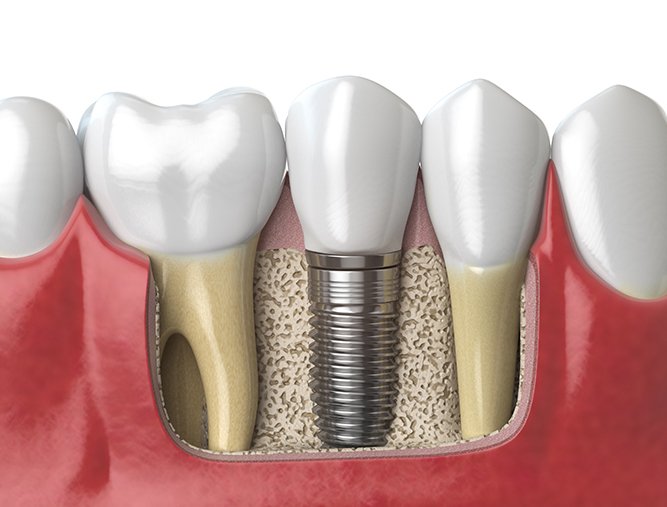 Animated dental implant supported dental crown