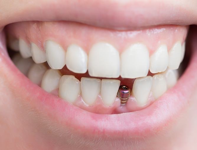 Closeup of smile with dental implant post visible above the gums