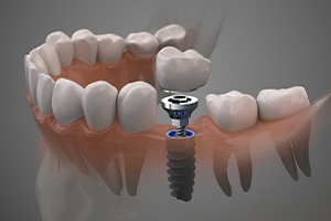 Animated dental implant supported dental crown