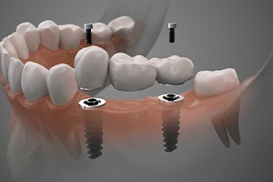 Animated dental implant supported fixed bridge