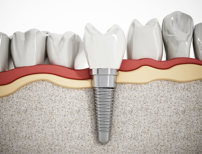 Animated dental implant supported dental crown