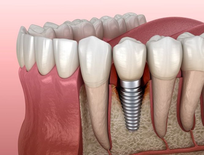 Peri-implantitis infection around dental implant