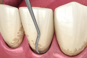 Illustration of teeth being cleaned