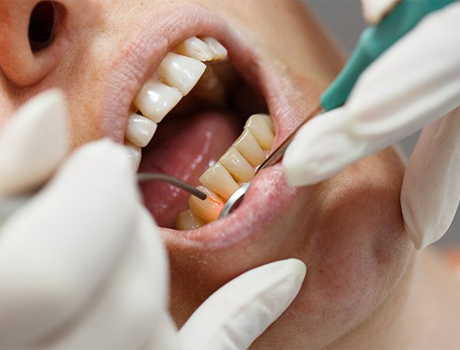 Patient receiving soft tissue diode laser dentistry
