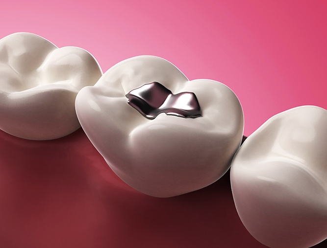 Animated smile with silver filling