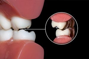 Animated smile during teeth grinding