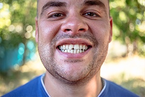 Man's smile with chipped front tooth