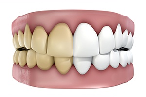 Animated smile before and after teeth whitening