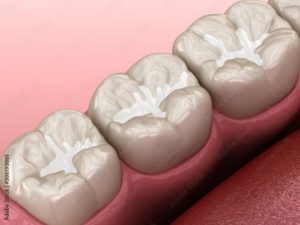 Image of teeth with dental sealants.