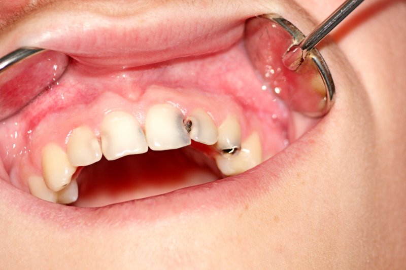 A closeup of a mouth with a cavity between teeth